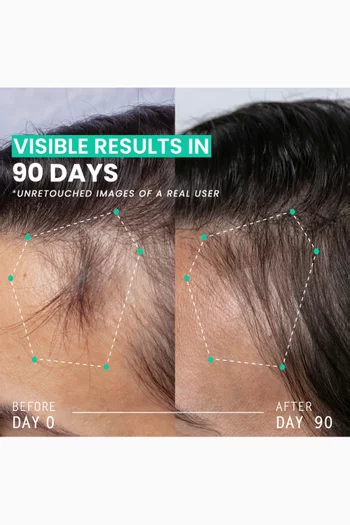روتين مزدوج الاعلية لزيادة كثافة الشعر - حل لتساقط الشعر في 90 يوم